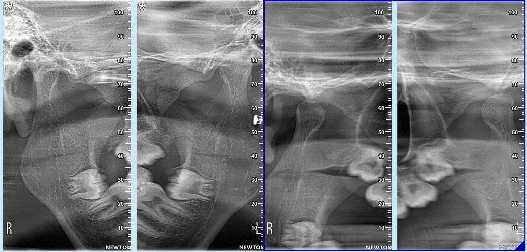 2D TMJ - 2D TMJ Imaging