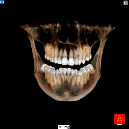 SCAN - 3D CBCT Scan