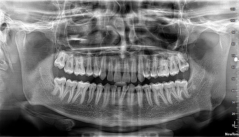 OPG - Orthopantomogram (OPG)