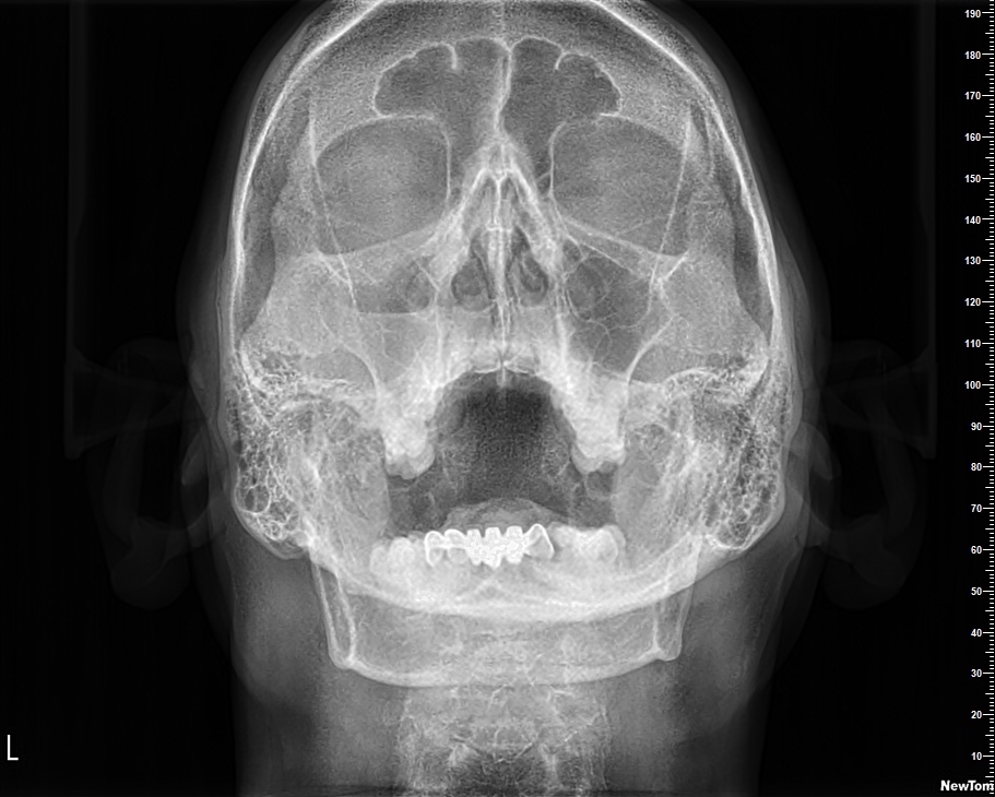 PNS - Paranasal Sinus (PNS) View