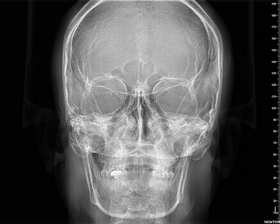 AP - Anteroposterior (AP) View