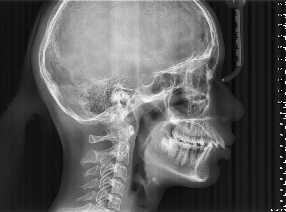 CEPH - Lateral Cephalometric Radiograph