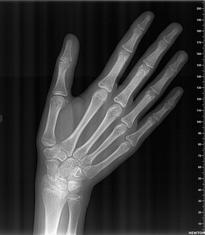 HAND WRIST - Hand Wrist Radiograph
